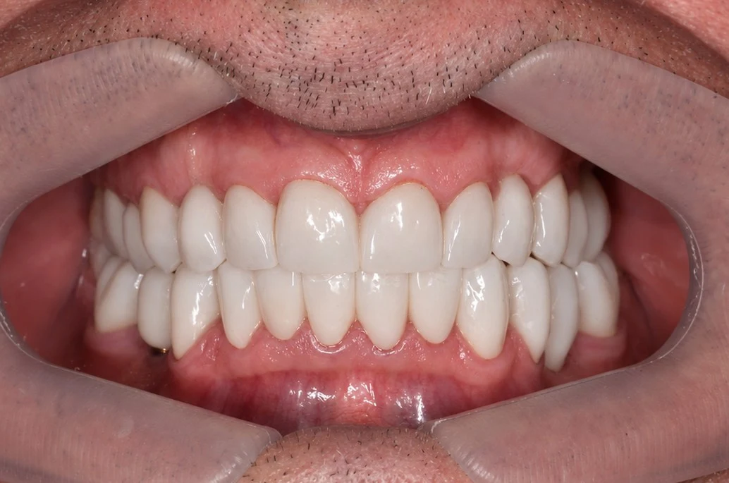 Desgaste dental anterior previo a reconstrucción con carillas